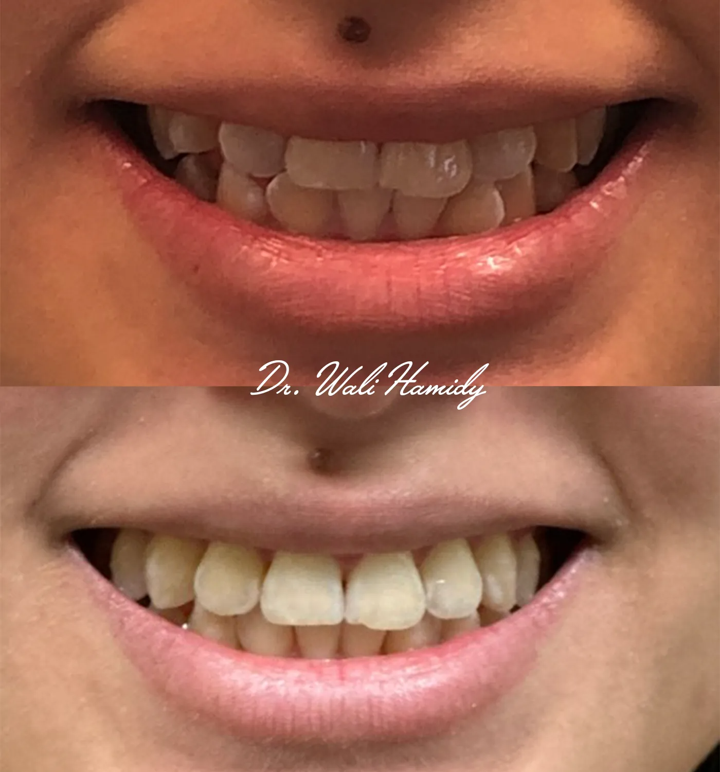 invisalign2 gallery