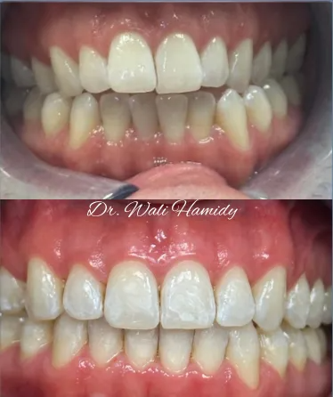invisalign2 gallery