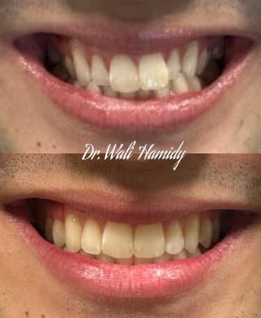 invisalign2 gallery