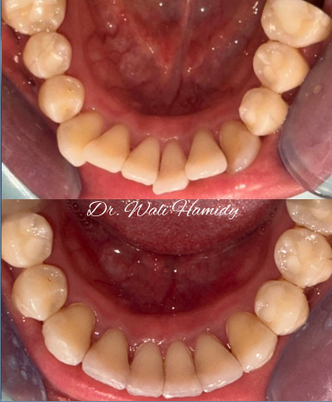 invisalign2 gallery