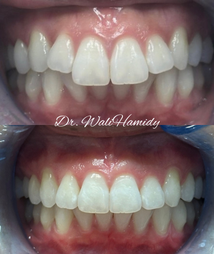 invisalign2 gallery
