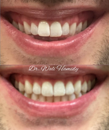 invisalign2 gallery