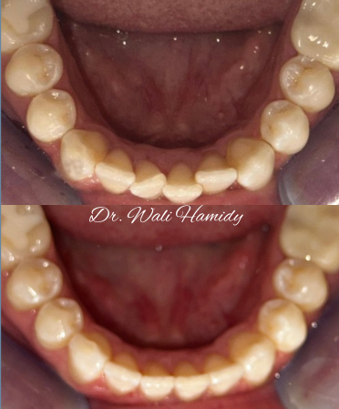 invisalign2 gallery