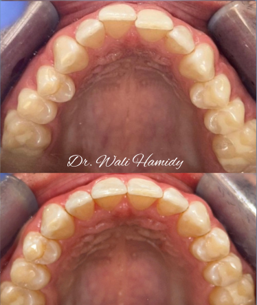 invisalign2 gallery