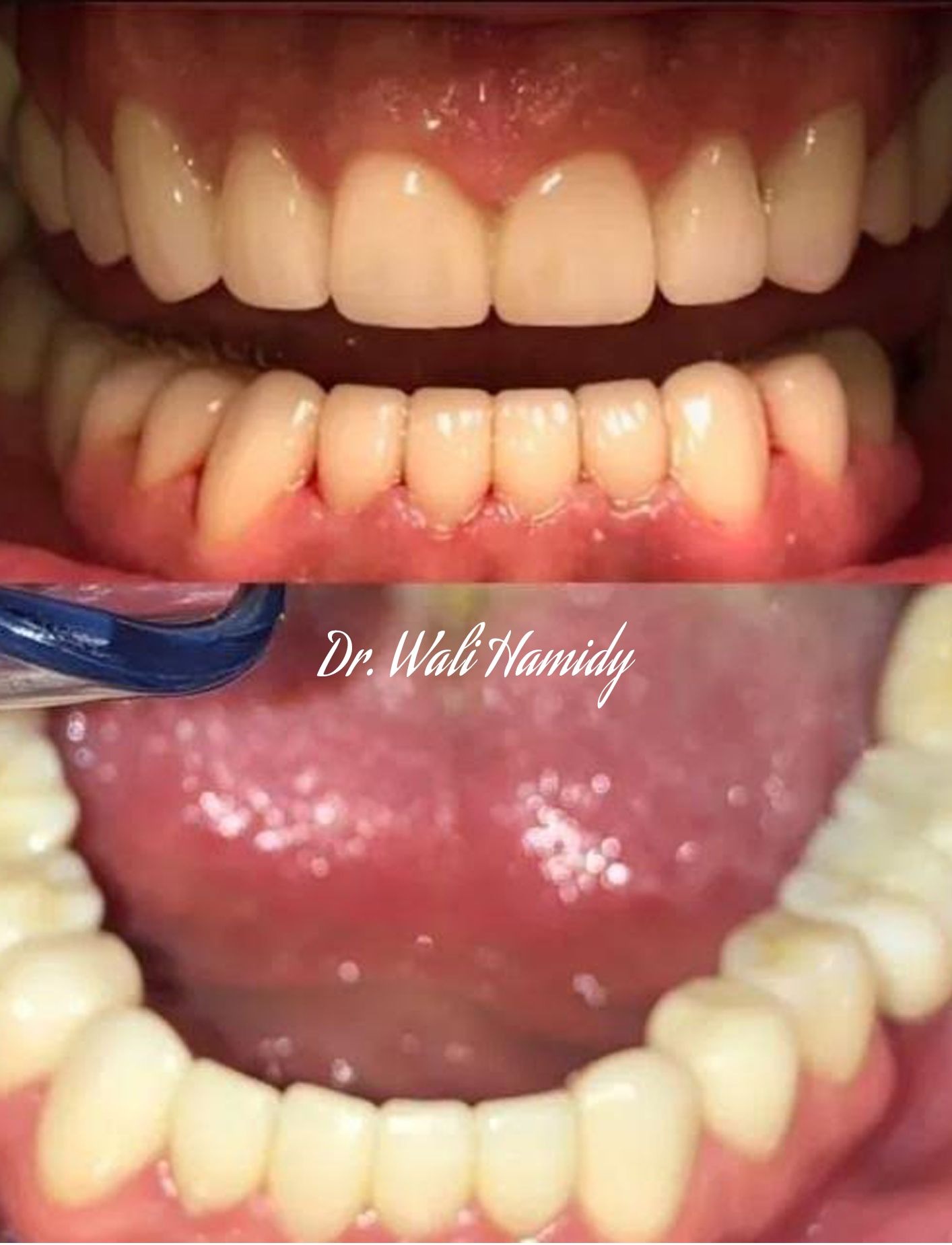 invisalign2 gallery