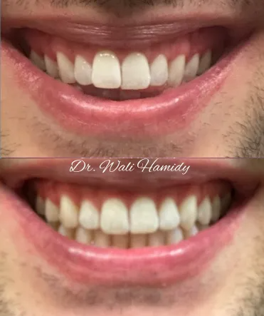 invisalign2 gallery