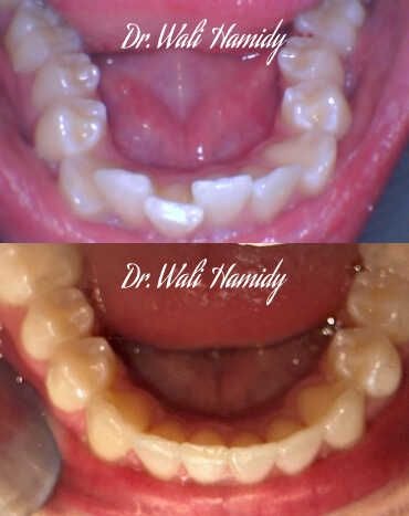 invisalign2 gallery