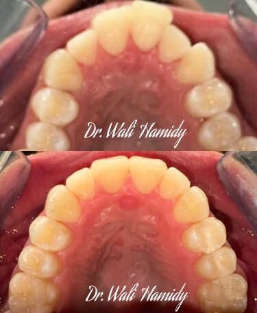 invisalign2 gallery