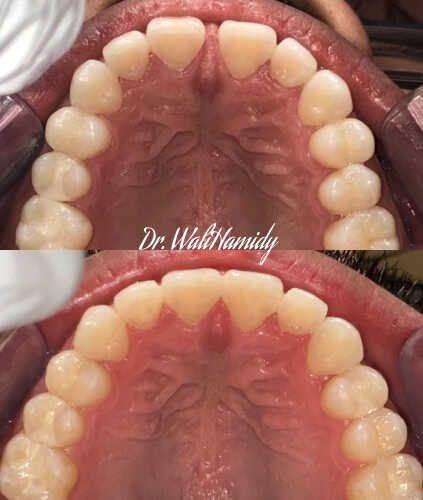 invisalign2 gallery