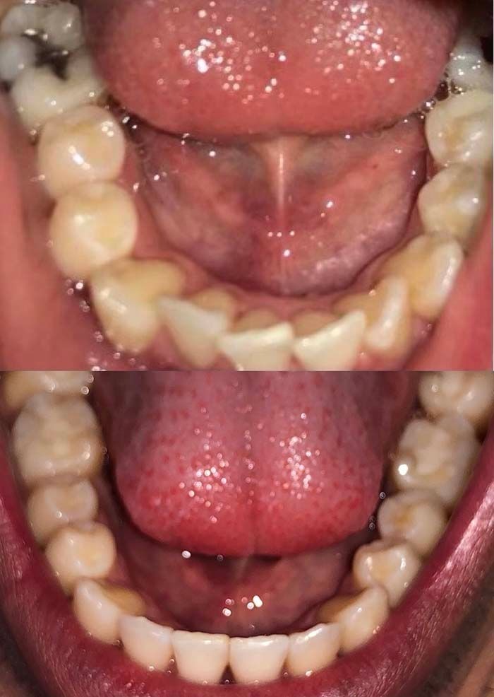 invisalign2 gallery