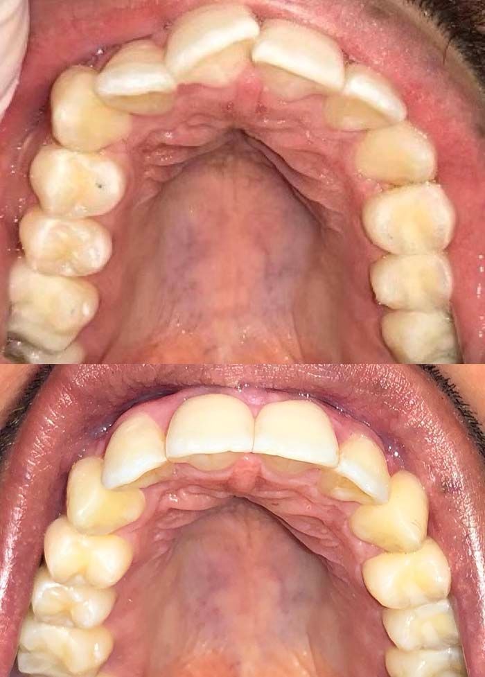invisalign2 gallery