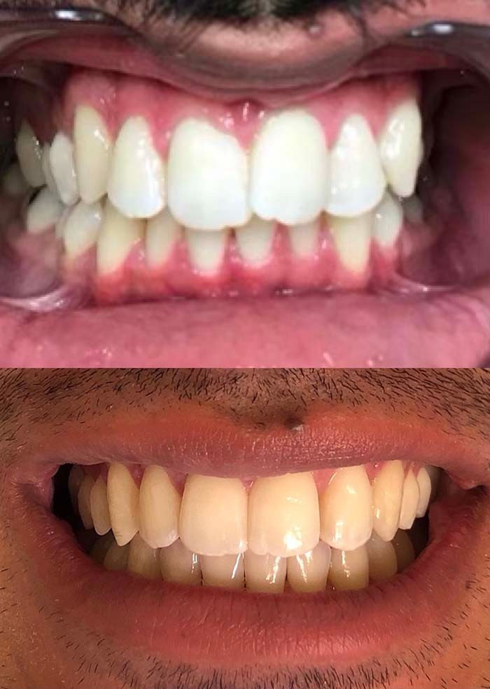 invisalign2 gallery