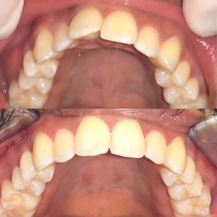 invisalign2 gallery