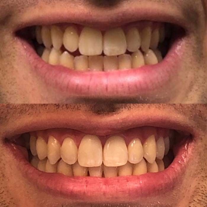 invisalign2 gallery