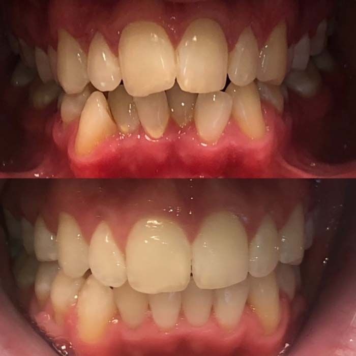 invisalign2 gallery