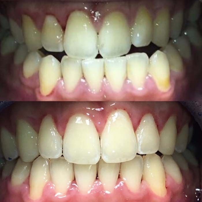 invisalign2 gallery