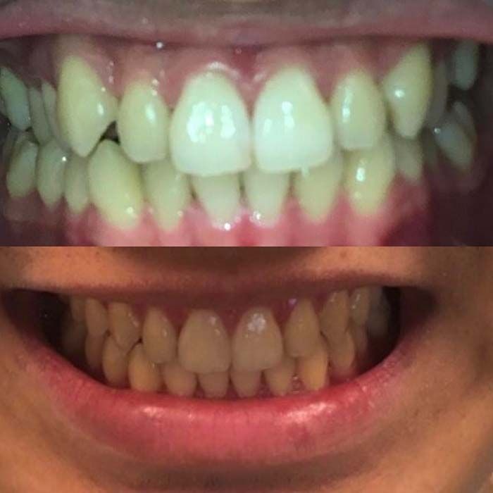 invisalign2 gallery