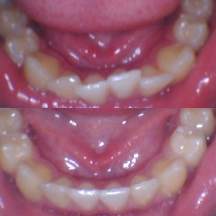 invisalign2 gallery