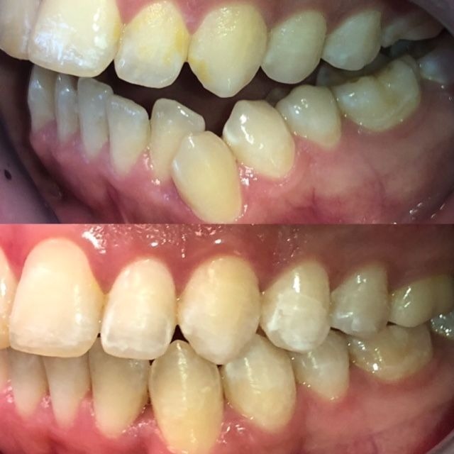 invisalign2 gallery