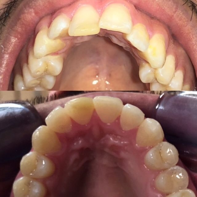 invisalign2 gallery