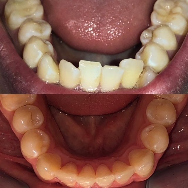 invisalign2 gallery